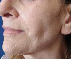 Secret RF Before & After Patient #1619